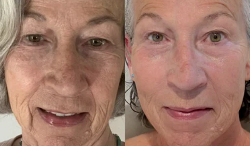 REDUCE LINES & WRINKLES