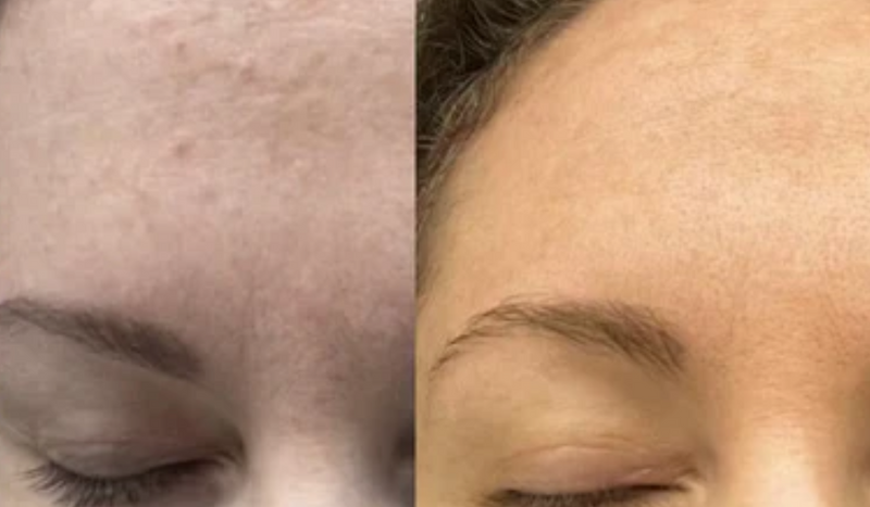 IMPROVE SKIN TEXTURE